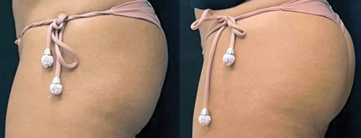 O antes e depois de uma paciente do Clube do Bumbum