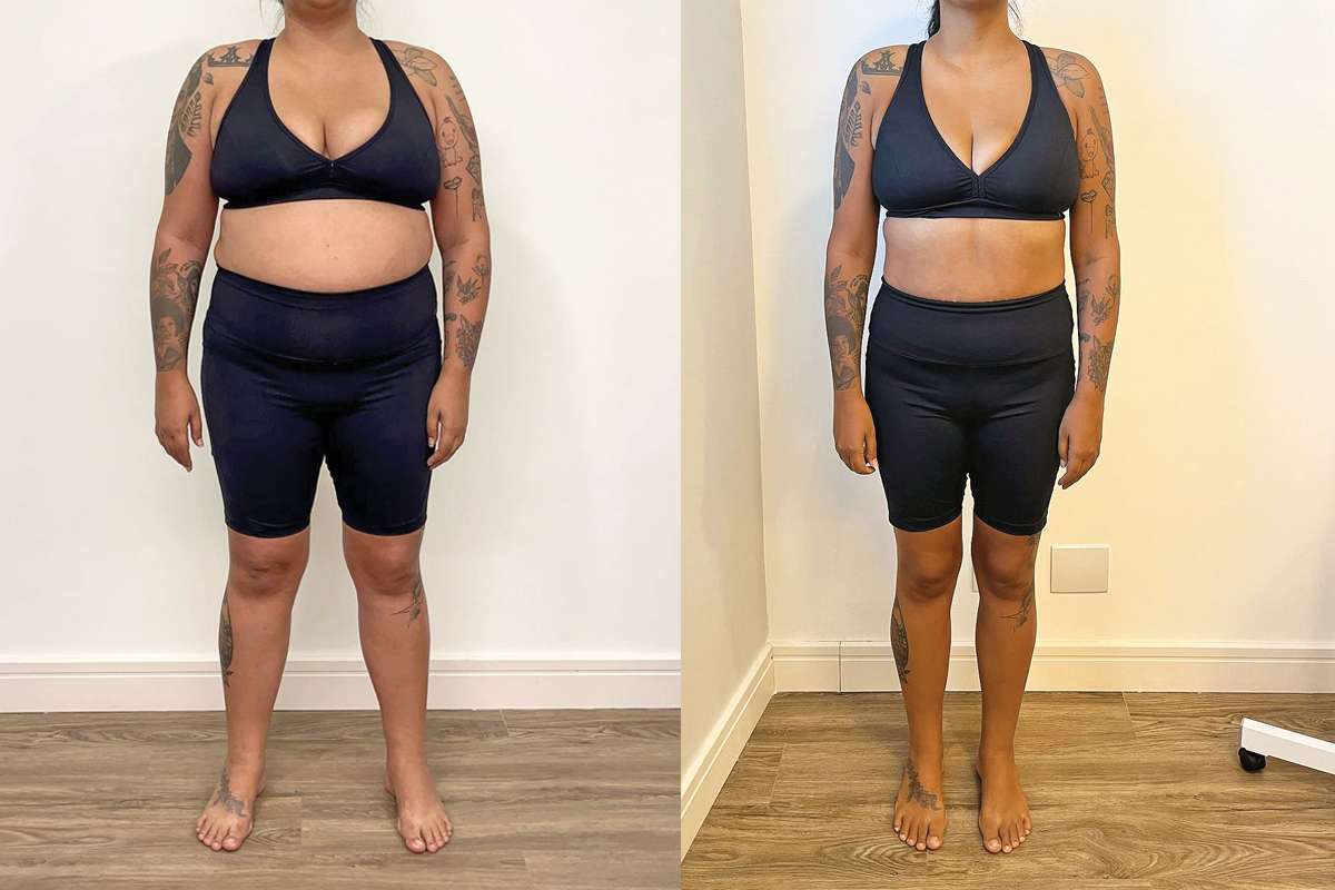 Raquel iniciou o Programa de Saúde e Bem-Estar com o Dr. Igor Alves dia 30/09/2024. Nas primeiras 11 semanas, já havia eliminado 20kg de gordura e sua insulina já tinha normalizado. Nessas fotos, a diferença é de 30kg perdidos de maneira leve e consistente.