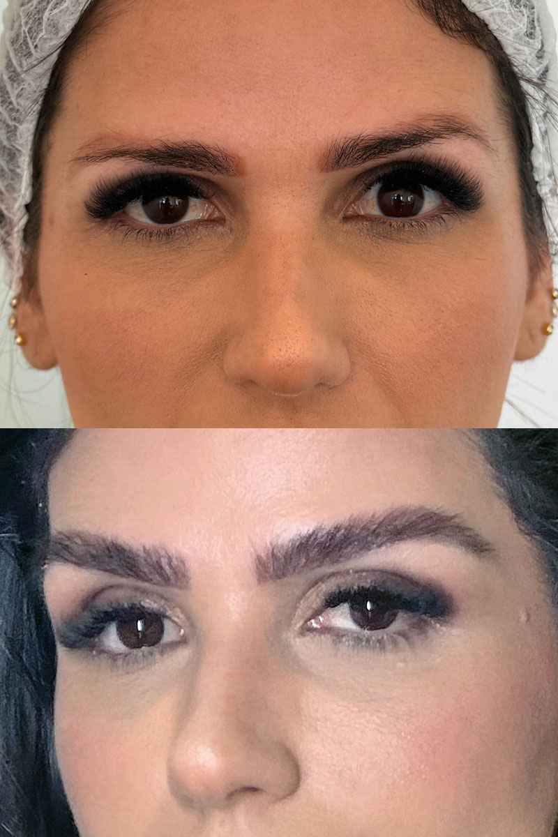 O antes e depois de Vívian Maciel Barbosa de Carvalho. Ela fez o transplante de sobrancelha na Capillum e diz que o que mais chamou sua atenção foi a delicadeza da técnica e a naturalidade do resultado. (Foto arquivo)