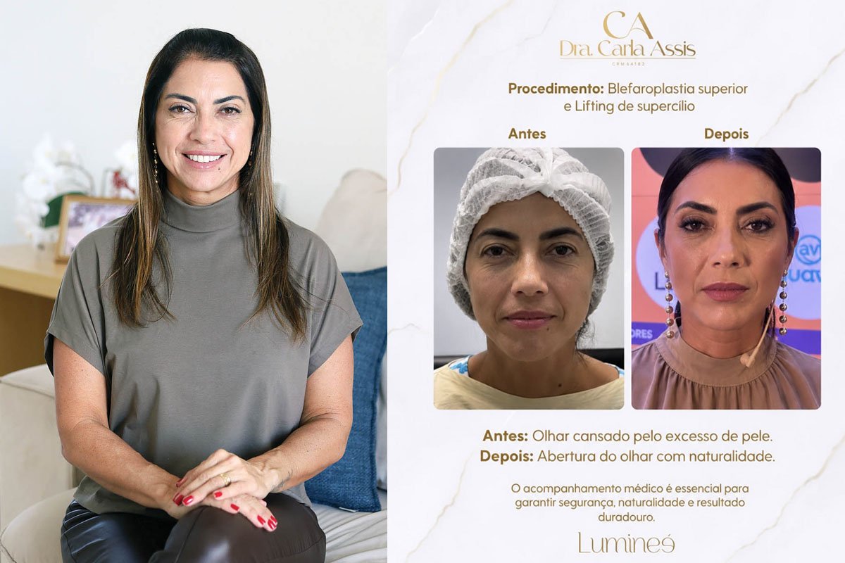 A nutricionista infantil Cinthia Melo fez a blefaroplastia. Ela se sentia incomodada com o aspecto de cansaço no olhar, mas tudo mudou depois da cirurgia. (Foto Alle Tavares)